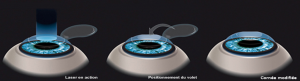Les Troubles de la Réfraction - Chirurgie Lasik Les Troubles de la Réfraction - Chirurgie Lasik